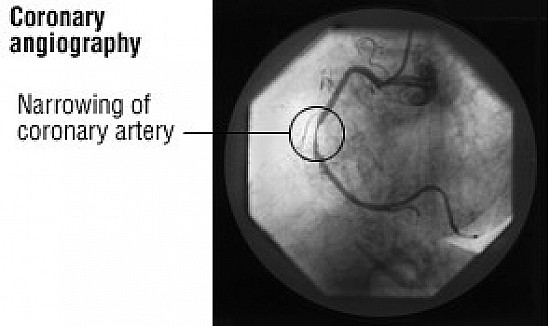 Cardiac catheterization featured image