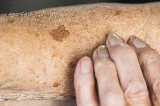 What's the difference between age spots and sun spots? featured image