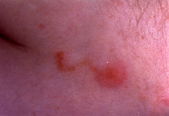 Scabies featured image