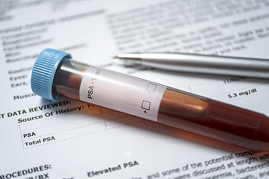Young men with prostate cancer: Socioeconomic factors affect lifespan featured image