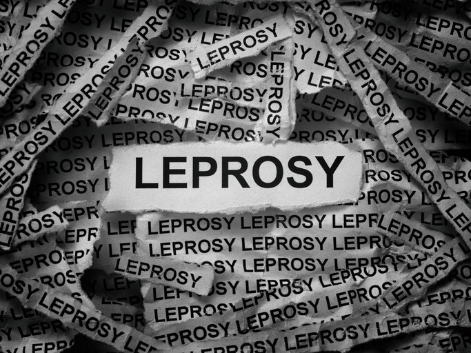 Leprosy in Florida: How worried should we be?