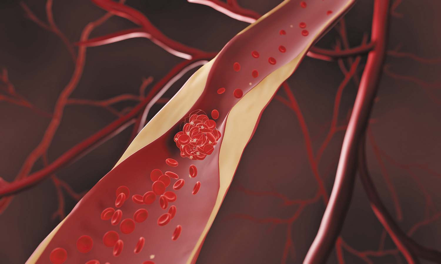 illustration showing plaque buildup in a blood vessel and a clot forming in the narrowed portion