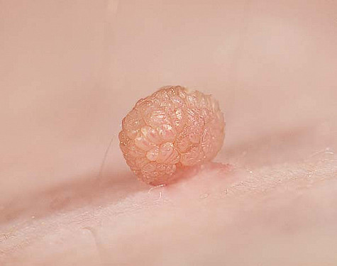 Why am I prone to skin tags? featured image
