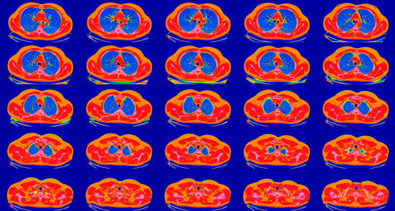 New guidelines aim to screen millions more for lung cancer