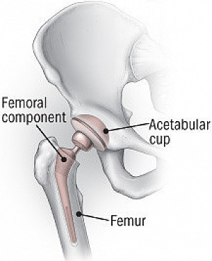 Hip fracture featured image