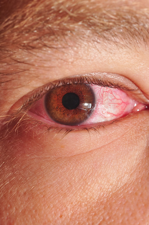 Close-up of someone with pinkeye
