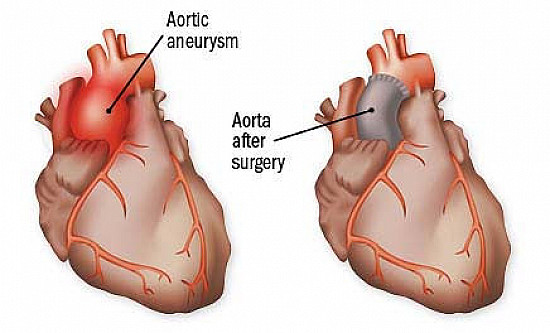 Repairing a thoracic aneurysm featured image