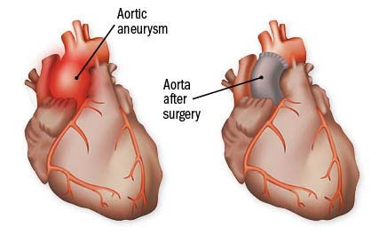 illustration of a heart showing an aortic aneurysm, next to an illustration of a heart showing the aorta after the aneurysm has been surgically repaired