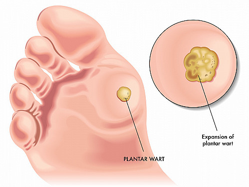 Warts featured image