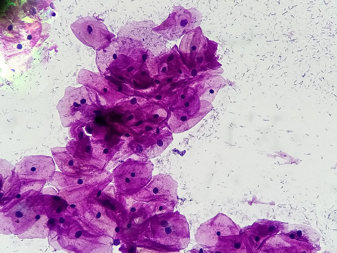 Late-stage cervical cancer on the rise: What to know