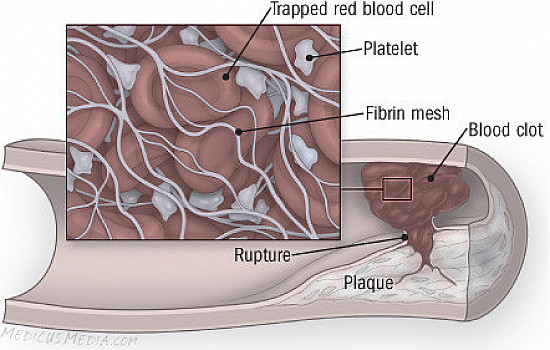 Angina featured image
