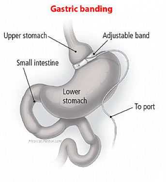 Gov. Christie’s weight-loss surgery: a good idea for health featured image