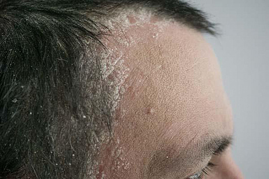 Scalp psoriasis: What to know about this uncomfortable inflammatory skin condition featured image