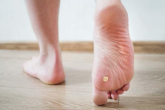 Plantar warts: Options for treating this common foot condition featured image
