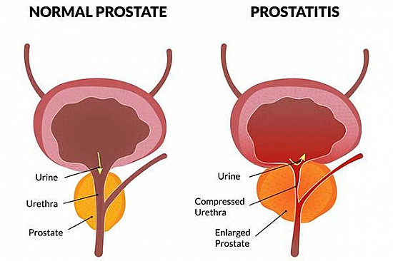 What is prostatitis and how is it treated? featured image