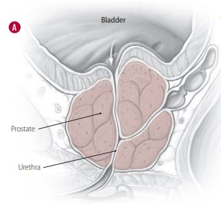 Your benign prostatic hyperplasia medication: When to consider a change