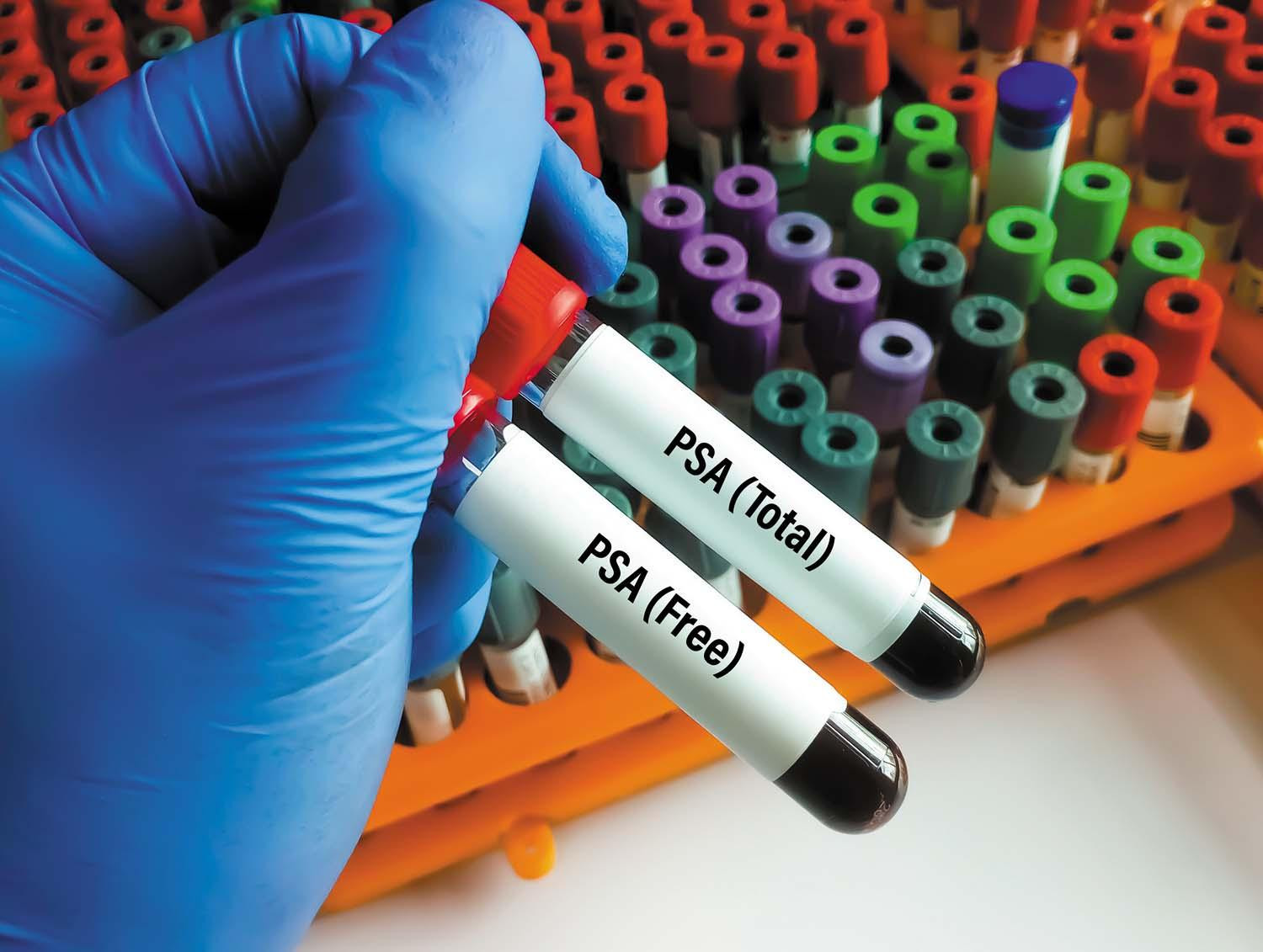 Finding advanced prostate cancers
