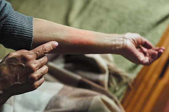 When should I see a doctor about a bug bite? featured image