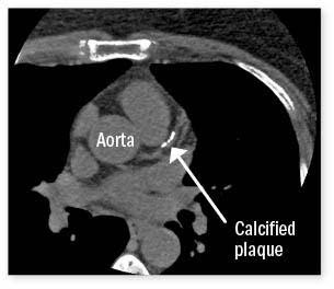 Image from a calcium scan with an arrow pointing to calcified plaque in the heart's arteries.