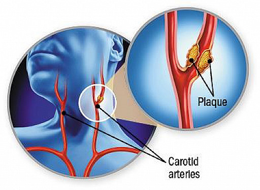 How are clogged neck arteries treated? featured image