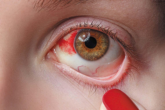 How did I break a blood vessel in my eye? featured image