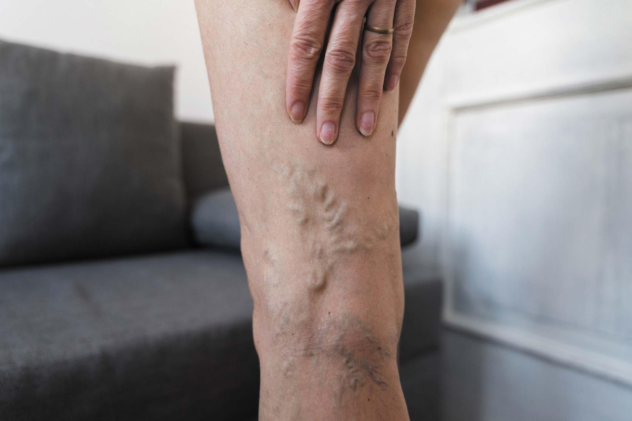 A person holding a hand to the back of their leg just above noticeable varicose veins.
