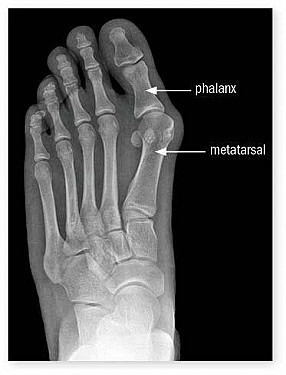 Do you really need bunion surgery? featured image