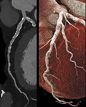 A faster, more accurate way to diagnose heart disease? featured image
