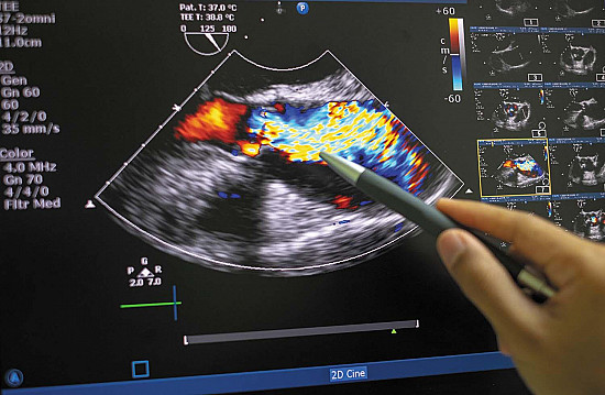 When the doctor needs a new heart valve featured image