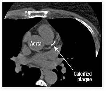 Calcium score, coaching, and statins may slow plaque buildup featured image