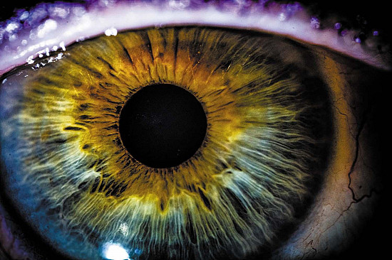 Cataract surgery may lower dementia risk featured image