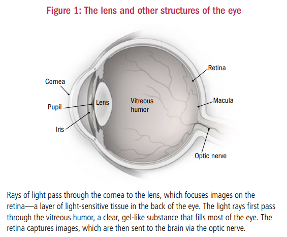 hb-cataracts-02-figure1