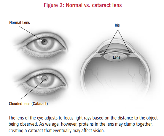 hb-cataracts-02-figure2